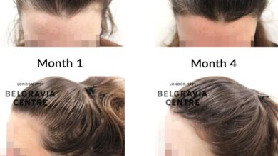 What is patterned hair loss in twenties treatment and solutions
