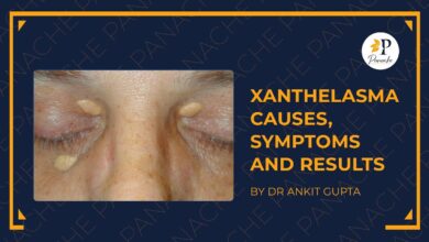What is xanthelasma know symptoms causes treatment