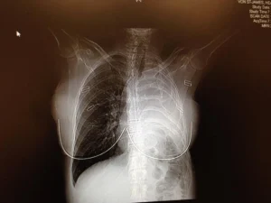 Decades After France Banned Asbestos, Accessing Compensation Remains a Major Challenge for Victims